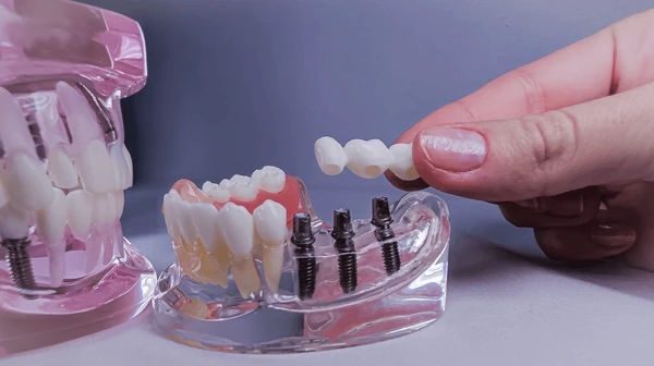 implant dentistry in riverdale