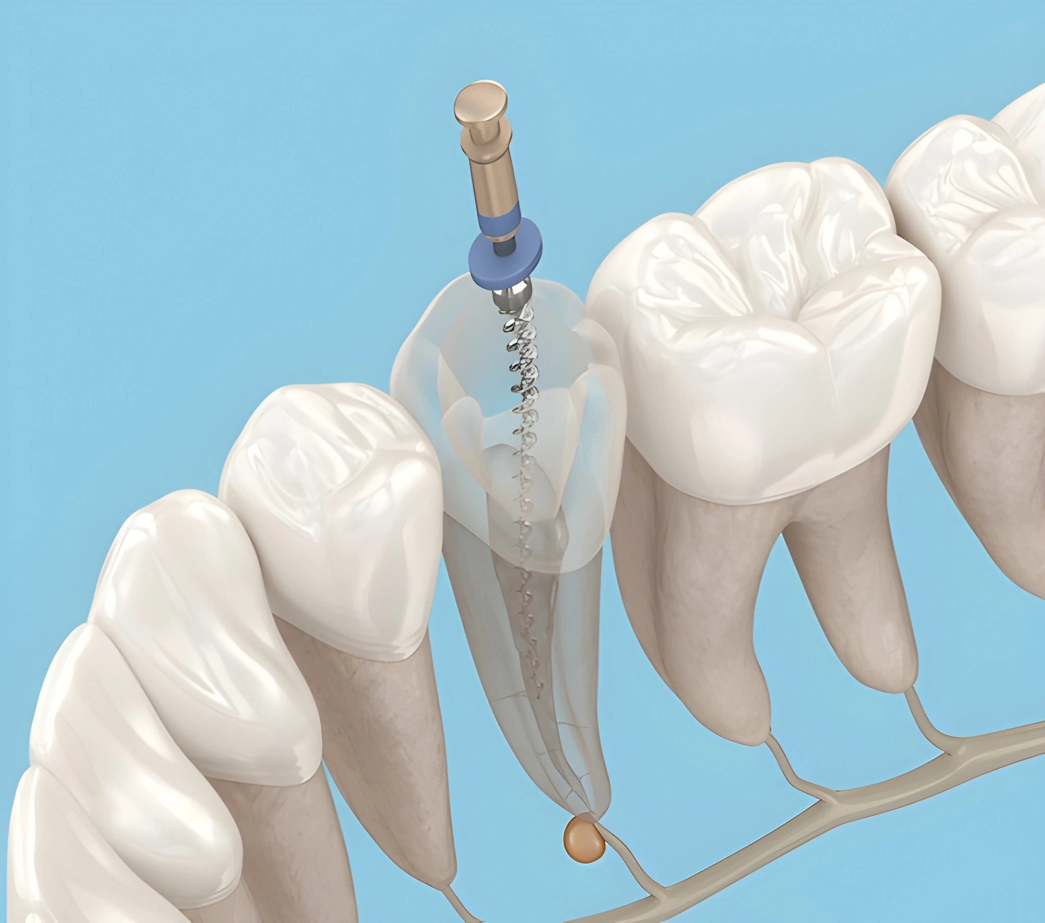 root canal treatment in riverdale