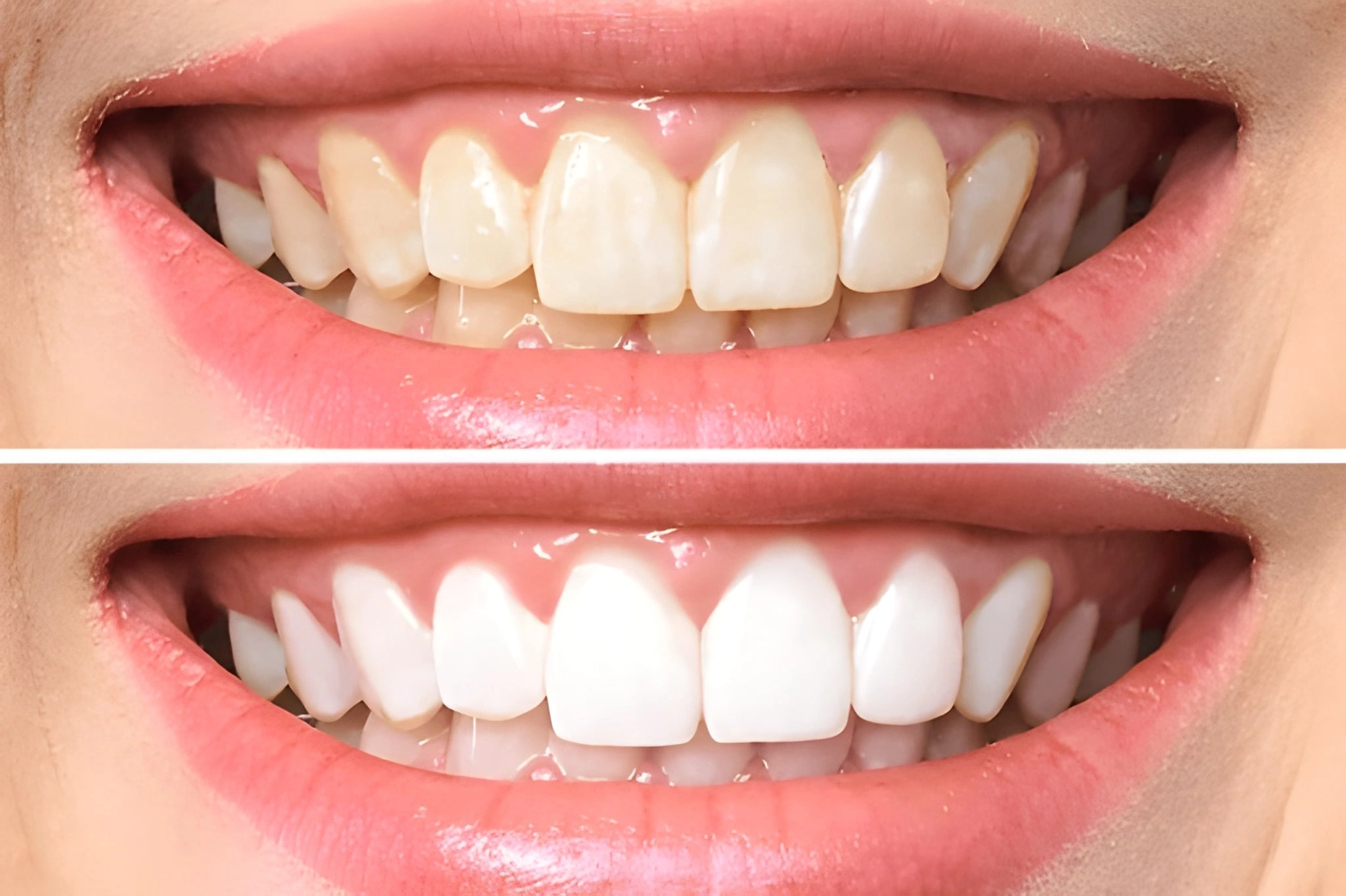 teeth whitening in riverdale