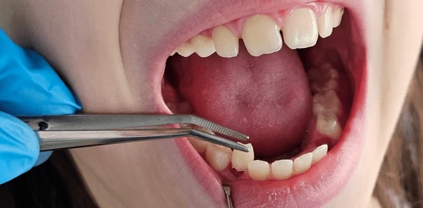 tooth extractions in riverdale