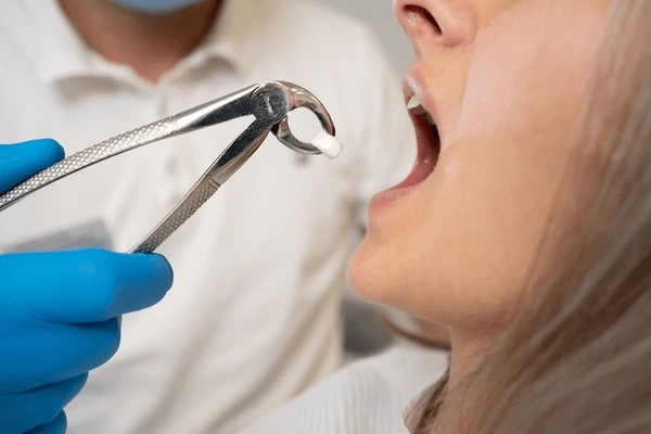 wisdom teeth removal in riverdale