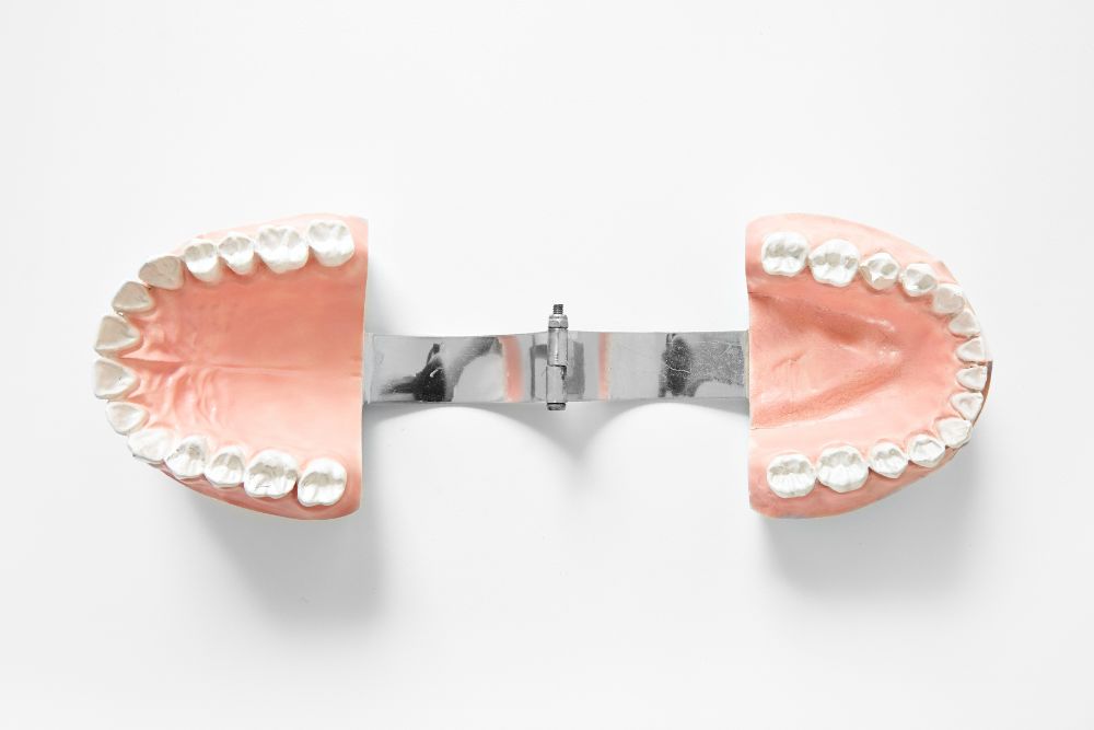 dental models showing upper and lower dentures
